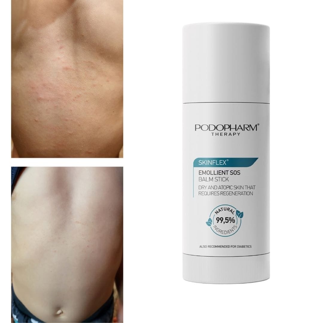 SKINFLEX® Verzachtende SOS Balsem Stick (PT 12)
