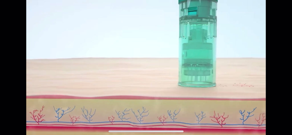 Microneedling