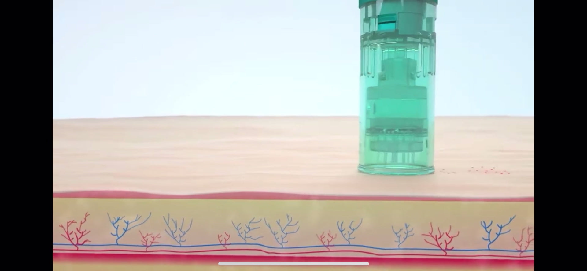 Microneedling